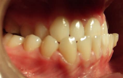 Malocclusion And Orthodontics Dr Sunil Dental Blog