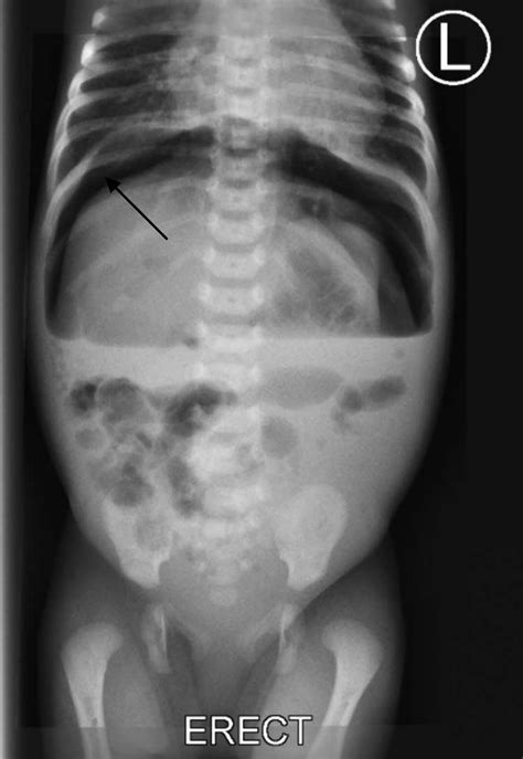 Plain Abdominal X Ray Shows Free Air Under Right Dome Of Diaphragm