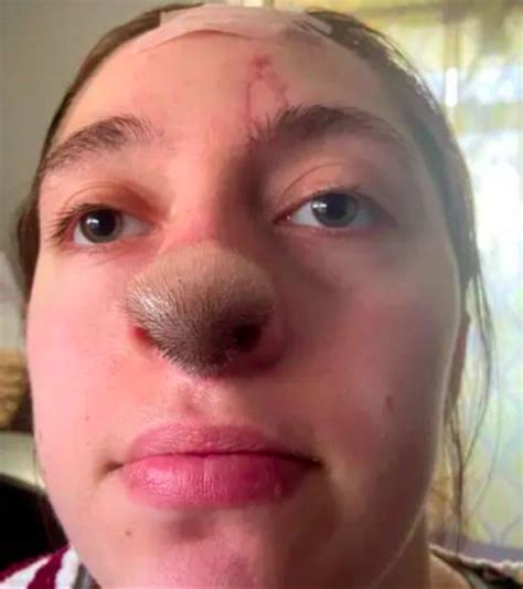 Mulher mordida por cão fica com pelo no nariz após enxertoFlipar