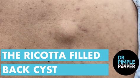 A Ricotta Filled Back Cyst Dr Pimple Popper