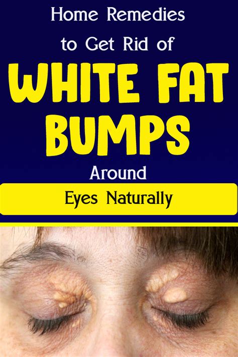 Home Remedies To Get Rid Of White Fat Bumps Around Eyes Naturally