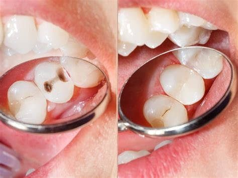 What Is A Composite Filling Magnolia Dental