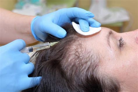Here, we have no possible link between hair thinning on scalp and beard growth/thinning. What Does It Mean if You Have Hair Loss on One Side of ...