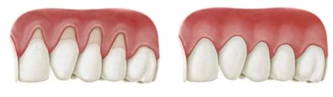 Receding Gums Blog 2 One Dental And Implant Clinic