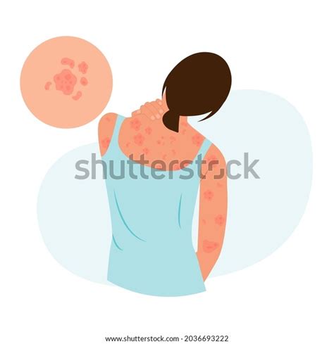 The Woman Is Scratching Her Back Allergic Itching Skin Inflammation