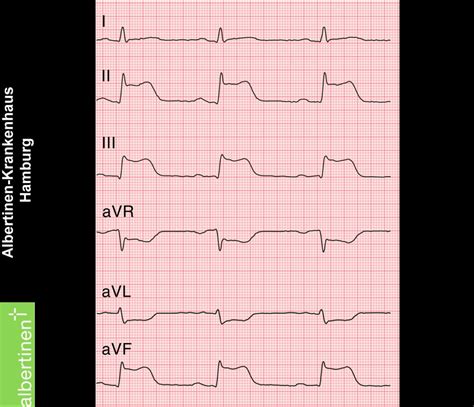 STEMI Posteriore Acuto ECG DocCheck