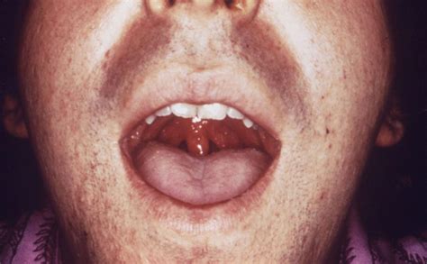 Oral Stds Pictures Types Symptoms Treatment And Prevention