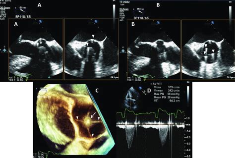 An Aortic Starr Edwards Edwards Lifesciences Irvine Ca Mechanical