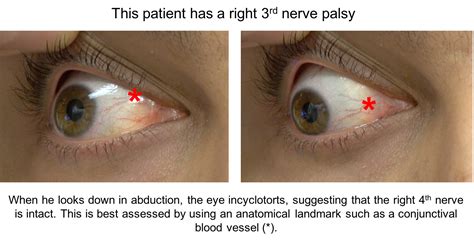 Fourth Nerve Palsy Case Based Neuro Ophthalmology