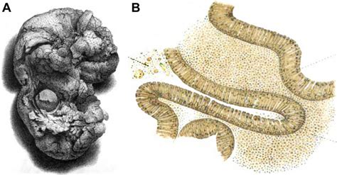 Gross A And Microscopic Appearance B Of Warthin Tumor Described In