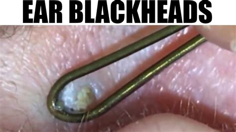 Ear Blackheads And Bonus Pickle Popping Must Watch Youtube