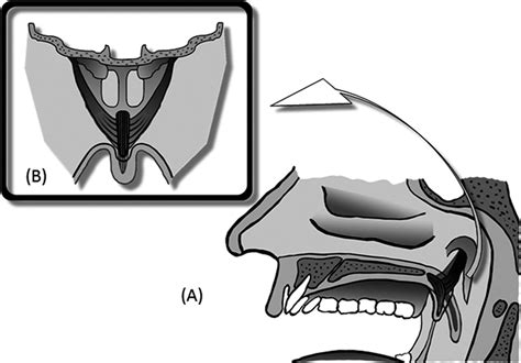 Relocation Pharyngoplasty Operative Techniques In Otolaryngology Head