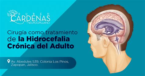 Hidrocefalia crónica del adulto Dr Rubén Cárdenas