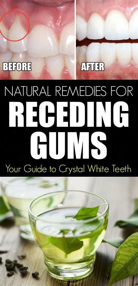Natural Remedies For Receding Gums Your Guide To Crystal White Teeth
