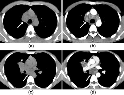 Differentiation Between Tuberculosis And Lymphoma In Mediastinal Lymph