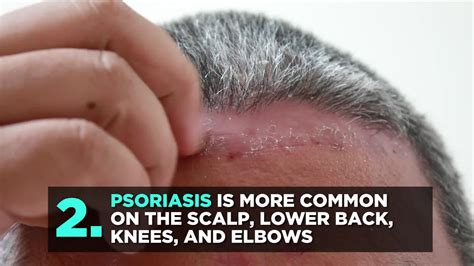 What Is Inverse Psoriasis—and Whats The Best Way To Treat It