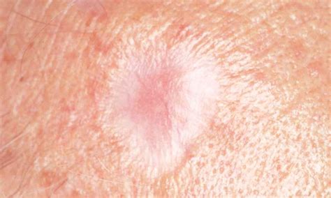 White Spots On Skin Cancer