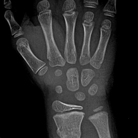 — Interactive Pediatric Wrist And Hand Radiograph Cases
