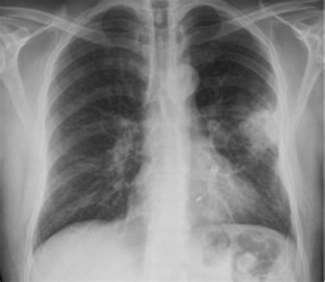 Frontal View Of The Chest Shows Left Hilar Calcification With A