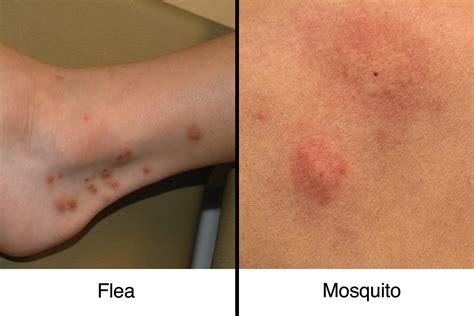 Picaduras De Pulgas Y Picaduras De Mosquitos C Mo Diferenciarlas Grain Of Sound