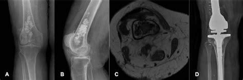 Dedifferentiated Chondrosarcoma A Case Series And Review Of The