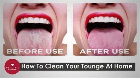 How To Clean Your Tongue Clean Your Tongue At Home Youtube