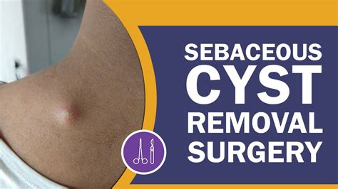 sebaceous cyst removal surgery what you need to know dr pk talwar youtube