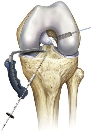 Clinical And Functional Outcome Of All Inside Anterior Cruciate