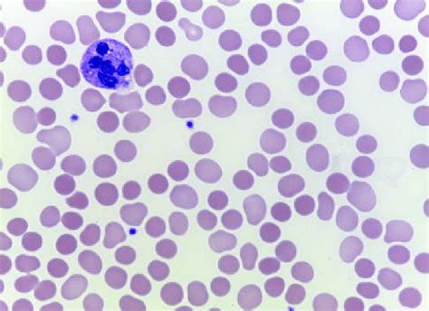 Autosomal dominant or recessive depending on which mutations are inherited. Peripheral blood smear of the patient with hereditary spherocytosis.... | Download Scientific ...