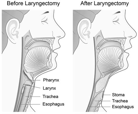 What Is Total Laryngectomy What Is Laryngectomy My Xxx Hot Girl