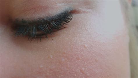 Beauty Skin Bumps Forehead Acne Skin Peeling On Face