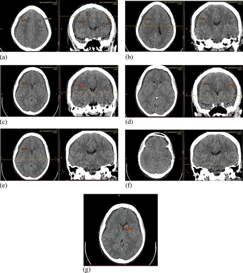 Image Of Patient Ct Scan Of The Patient At Different Levels Of Section