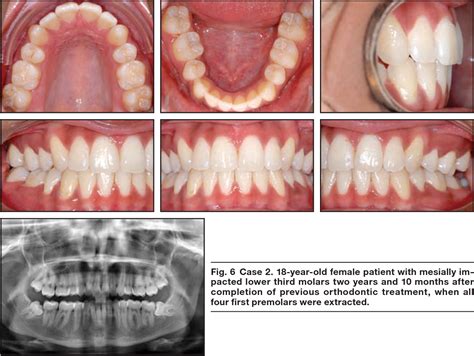 6 Year Old Molars Coming In Teethwalls