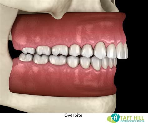 Overbite Teeth What Is An Overbite Or Buck Teeth Treatment Causes