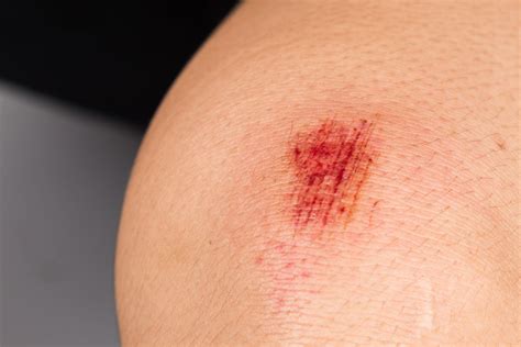 Abrasions Types Causes Treatments And More