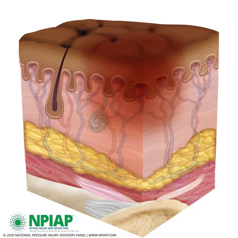 Pressure Injury Stages National Pressure Ulcer Advisory Panel