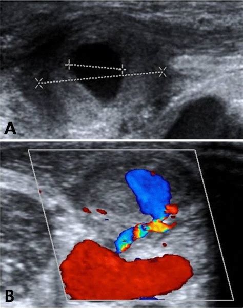 The Finding Of Carotid Doppler Sonography A Internal Diameter Of