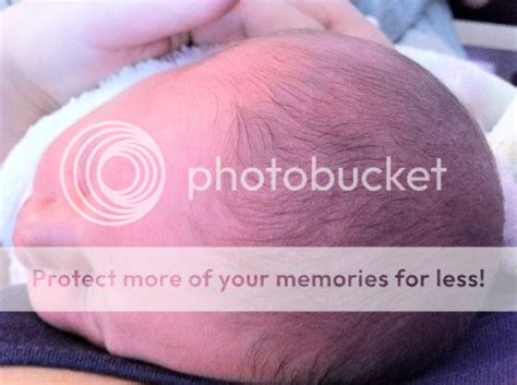 Bumps On Babies Scalp Pics Babycenter