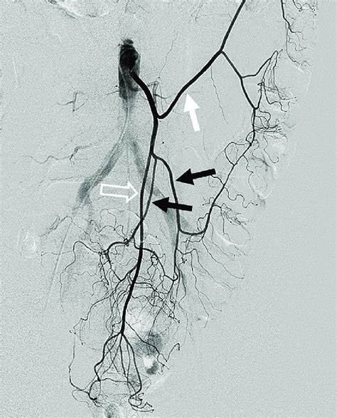 Inferior Mesenteric Angiogram For Suspected Active Bleeding From A