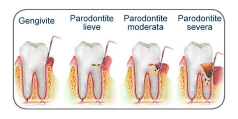 Parodontologia Piorrea Sintomi Cause Prevenzione Cure
