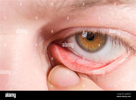 Red Lower Eyelid A Macro Photo Of The Human Eye Conjunctivitis