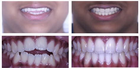 Before And After Orthodontic Treatment Gallery