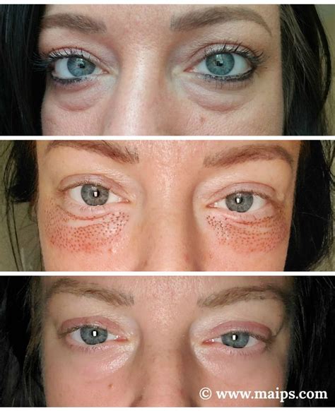 Laser Treatment For Under Eye Bags Medcoo