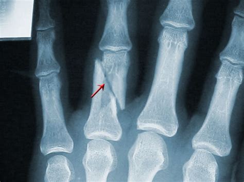 broken finger symptoms x ray tips treatment surgery and pictures broken finger broken bone
