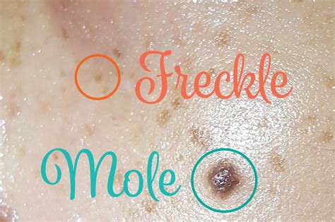 Difference Between Freckle And Mole Differences Finder