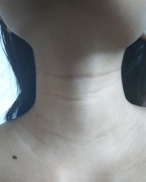 How To Get Rid Of These Lines The Lines On My Neck Have Always Been A