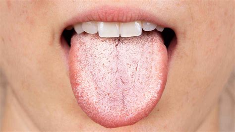 Vapers Tongue Why You Get It And How To Fix It