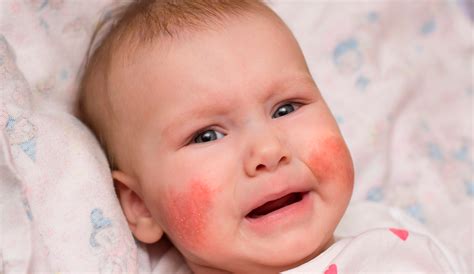 Infant Skin Rashes Pictures Pictures Of Childhood Rashes Red Dots