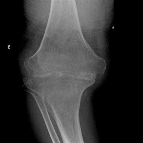 The Right Knee Radiograph Shows Concentric Joint Space Narrowing With