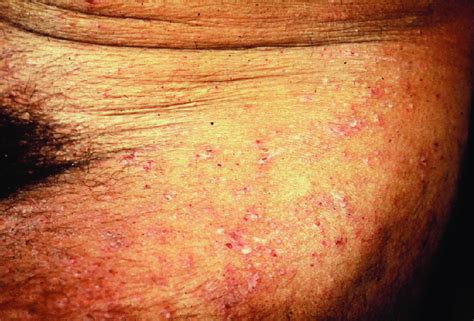 Scabies Rash Seen Around The Waist And Thighs A Common Polymorphic